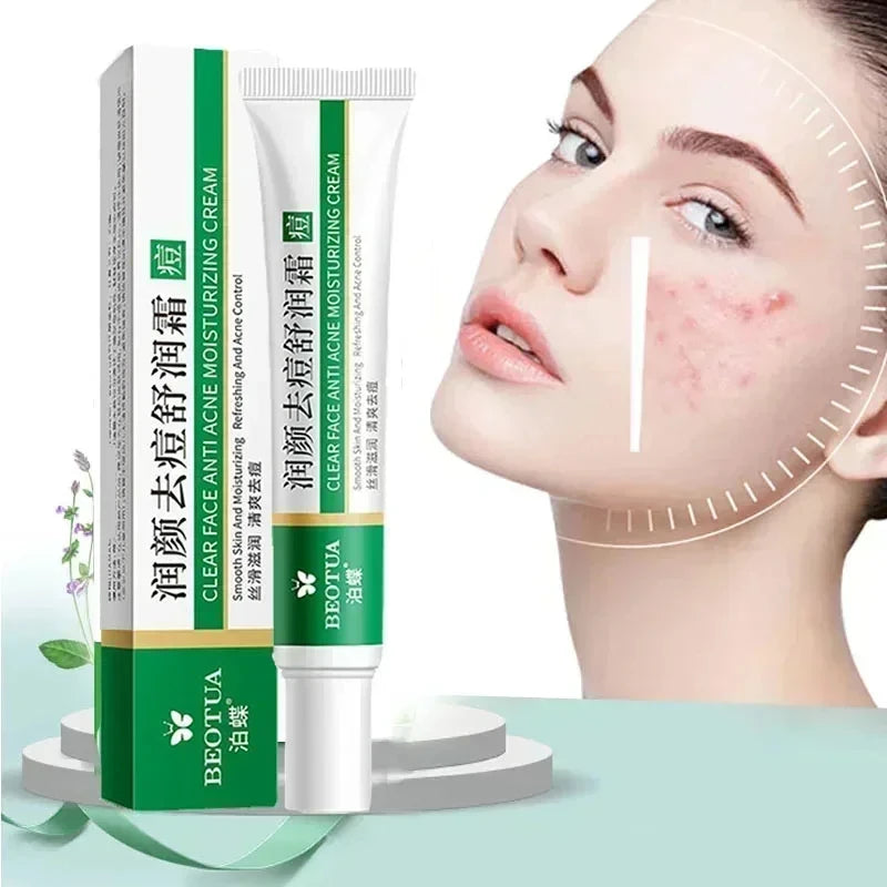 Herbal Acne Treatment Cream – Blackhead & Scar Repair